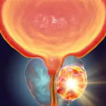 FODISAC – SENSIBILISATION AU CANCER DE LA PROSTATE